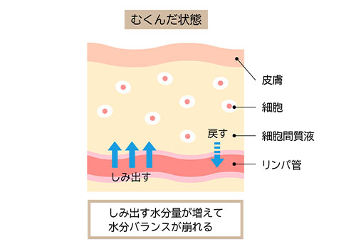 リンパ浮腫とは？