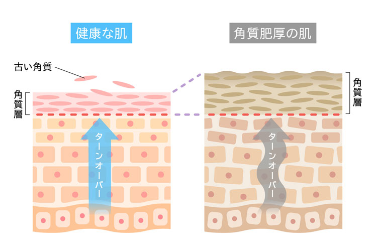 ケミカルピーリングとは？