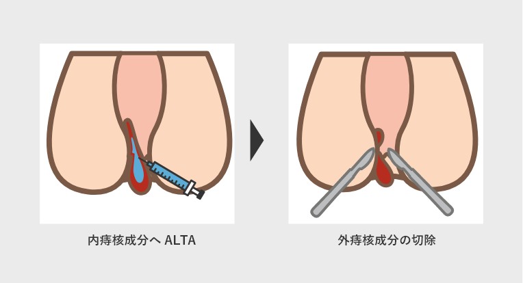 外痔核を切除するALTA併用療法画像