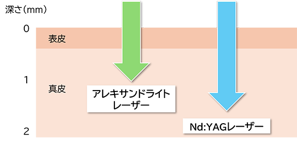 Nd:YAGレーザーが表皮にダメージを与えずに皮膚の真皮層に働きかけるイメージ画像